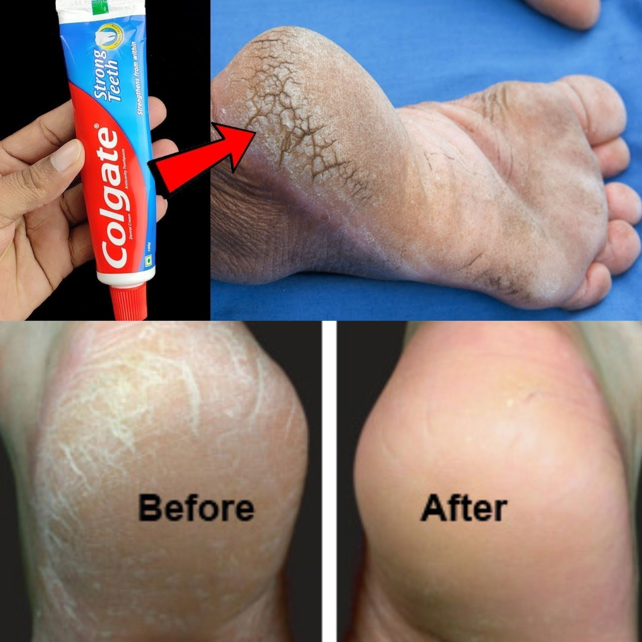 Remove Cracked Heels and Get Beautiful Feet Permanently in 3 Days with This Toothpaste Remedy