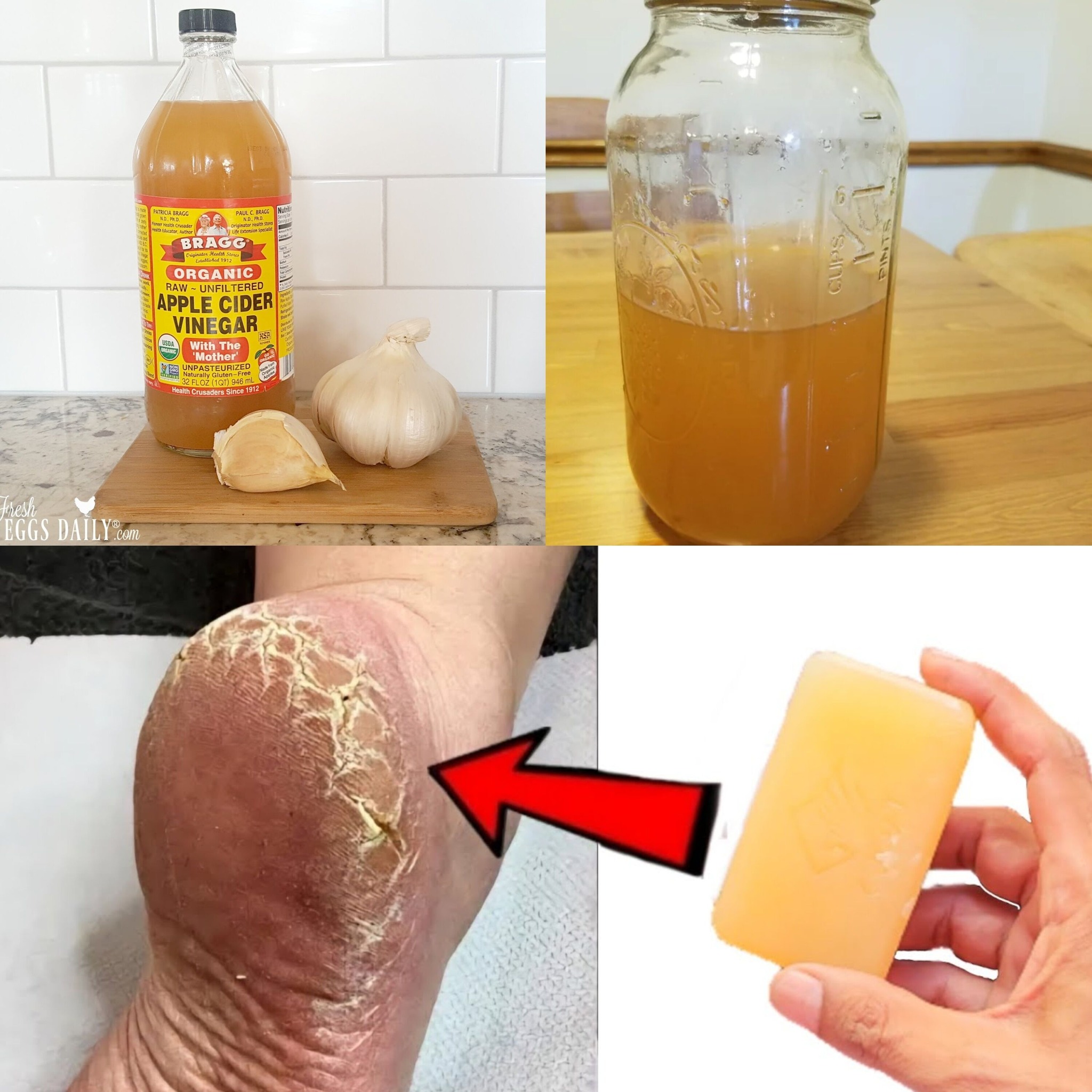 Magic Cracked Heels Home Treatment: Garlic, Starch, Bicarbonate, and Vinegar Paste