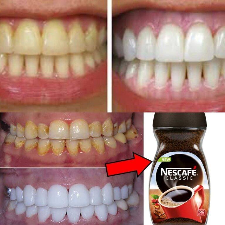 Teeth whitening at home in a natural and effective way in two minutes and a bright smile