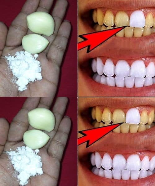 Garlic: A Surprising Friend for Making Teeth Whiter