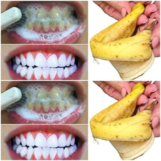 Fast TEETH WHITENING in 1 minute! 