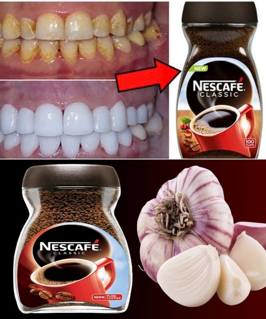 Teeth Whitening at Home in a Natural and Effective Way: Two Minutes to a Bright Smile with Garlic and Coffee