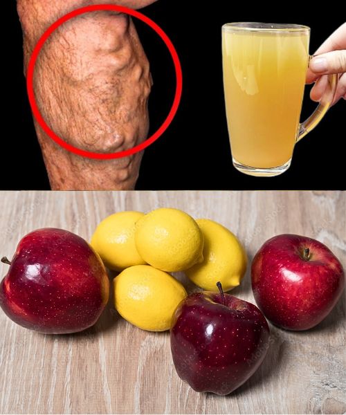 I AM SHOCKED! Dissolve Blood Clots and Boost Circulation with Apple and Lemon Juice!