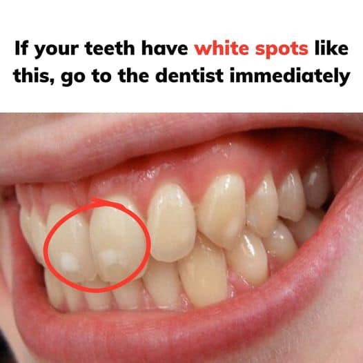 If your teeth have white spots like this, go to the dentist immediately