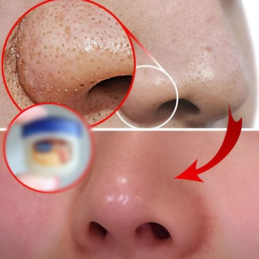 Remove blackheads on your nose with just a mixture of Vaseline