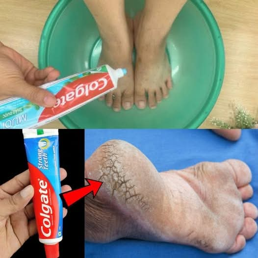 Remove Cracked Heels and Get Beautiful Feet Permanently in 3 Days: Home Remedy with Toothpaste