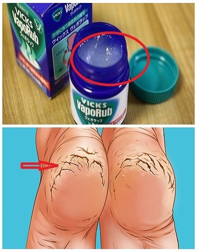 She rubbed Vicks Vaporub on her feet every night. The result will impress you